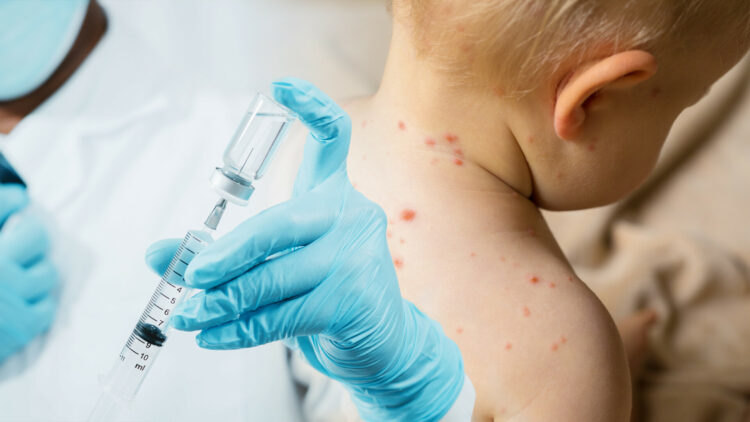 Ministarstvo zdravstva, rada i socijalne skrbi upozorava na pojavu morbila