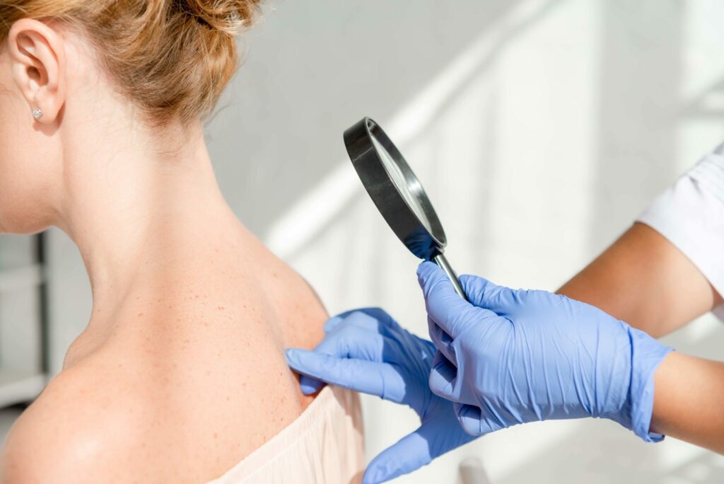 SKB: Besplatni dermatološki pregledi u sklopu kampanje Euromelanoma u Mostaru