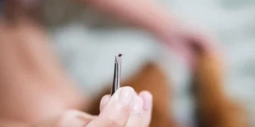 Što uraditi nakon ujeda krpelja i kada se javiti doktoru?